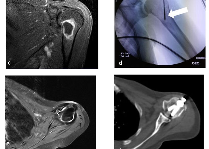 Giuseppe Brotzu Hospital Medicina | Free Full-Text | Combined Microwave Ablation and ... photo